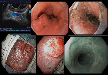 resection barrett avec tumeur