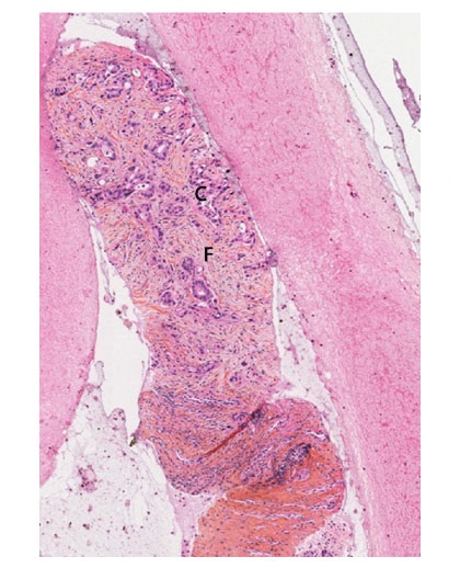 Pancréas - Biopsie obtenue par écho-endoscopie