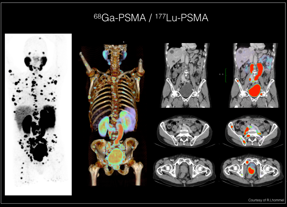 Le PSMA PET-CT