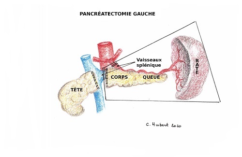 Pancréatetomie gauche - IRA II