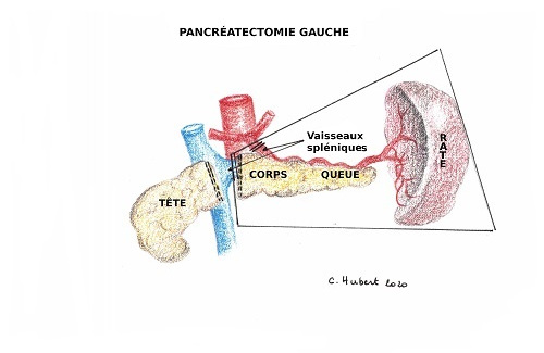 Pancréatectomie gauche - IRA II