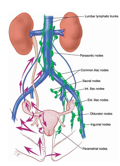 Cancer endomètre IRA II