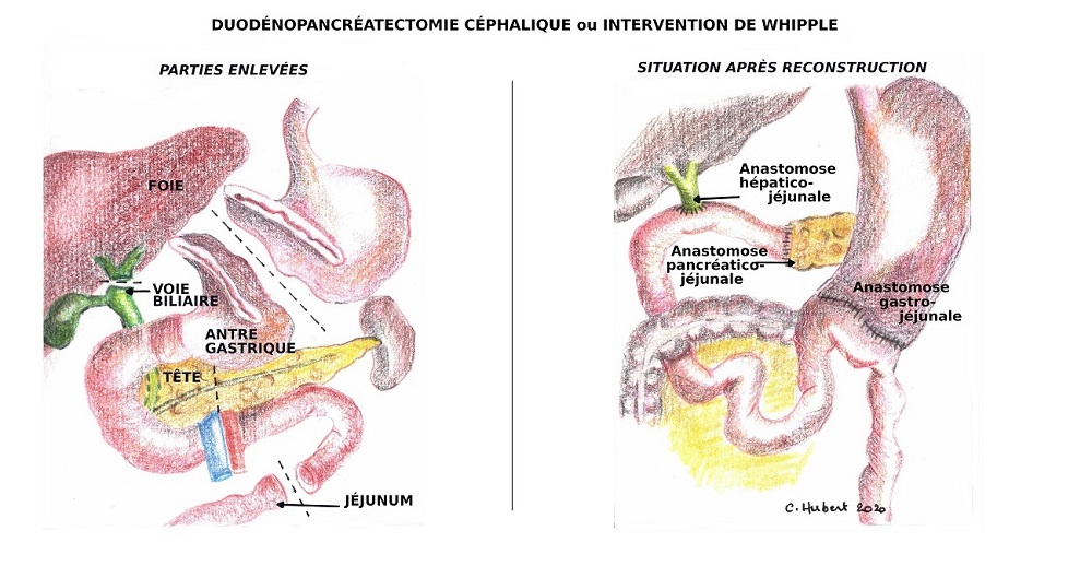  Duodénopancréatectomie céphalique » ou intervention de WHIPPLE - IRA II