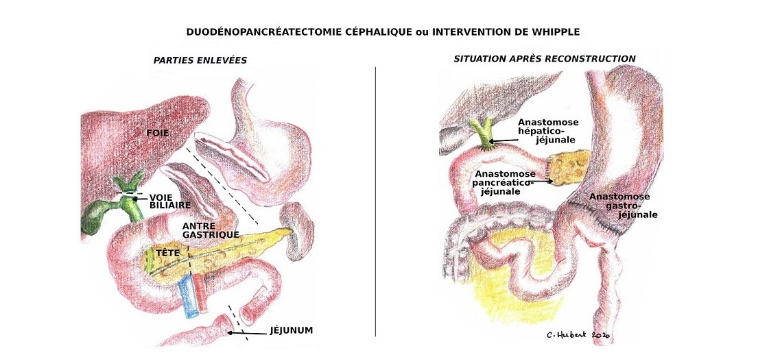 Whipple IRA II