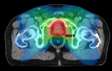 doses de radiothérapie administrées sur la prostate IRA II