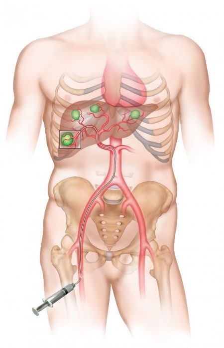 injection ITTRIUM