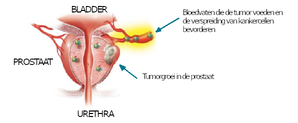 prostaatkanker