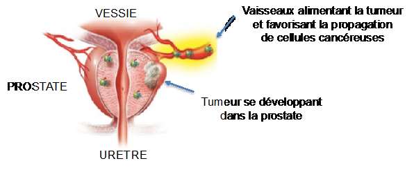 cancer de la prostate symptomes précoces