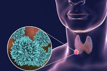 Prise en charge du microcarcinome thyroïdien - IRA II