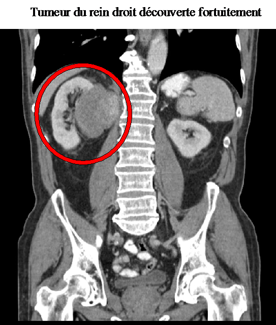 Cancer du rein | Institut Roi Albert II