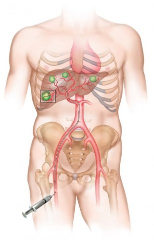 Radioembolisation ou radiothérapie interne sélective (SIRT) IRAII
