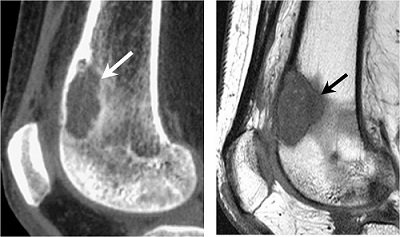 image diagnostic sarcome schubert site redim.jpg